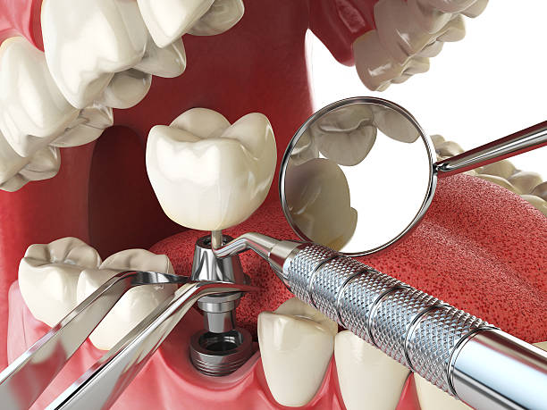 Best Emergency Wisdom Tooth Extraction in Lewiston, ID